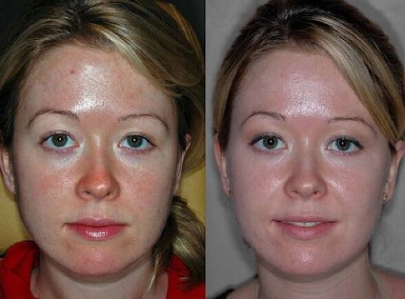 fotografije prije i nakon postupka pomlađivanja plazmom