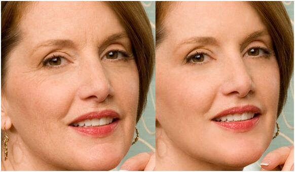 prije i poslije pomlađivanja kože lica plazmom