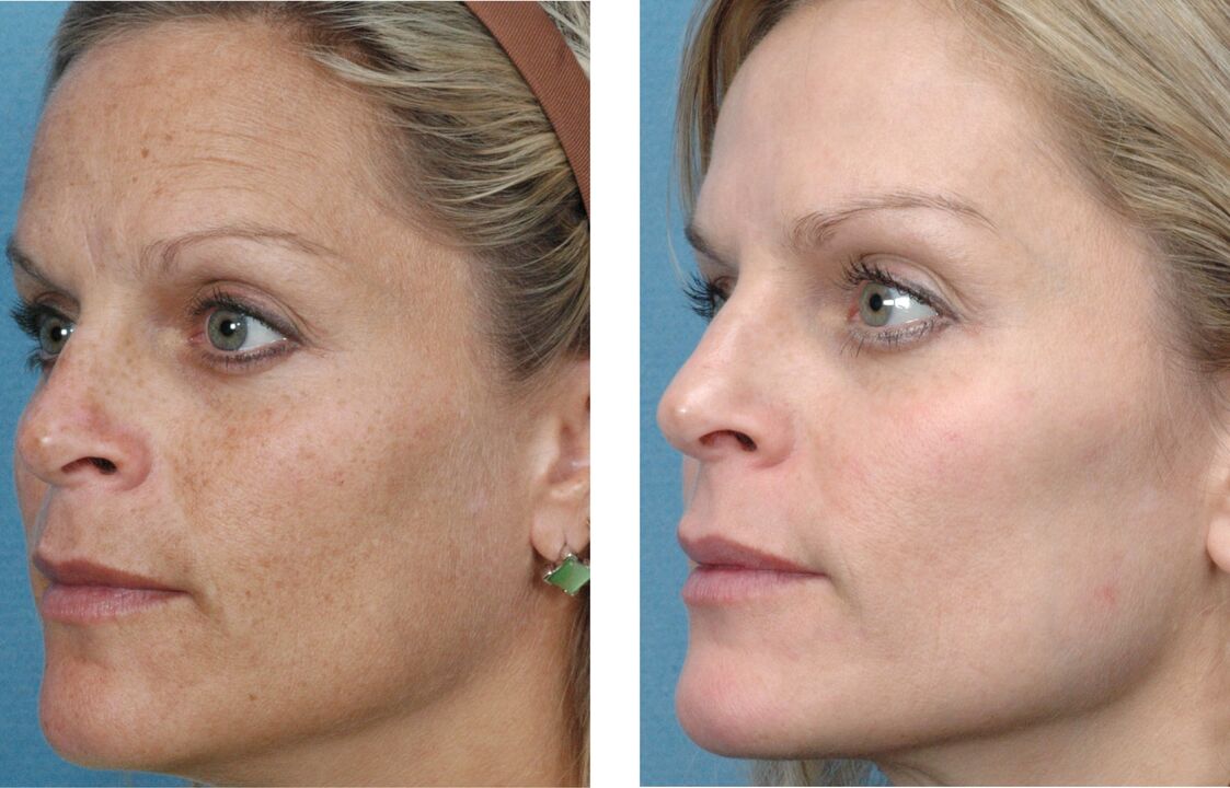 prije i poslije pomlađivanja kože fotografija 1