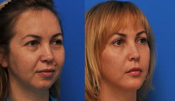 prije i poslije pomlađivanja kože sa zatezanjem fotografija 1