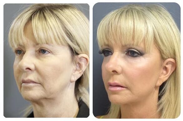 prije i poslije pomlađivanja kože sa zatezanjem fotografija 2
