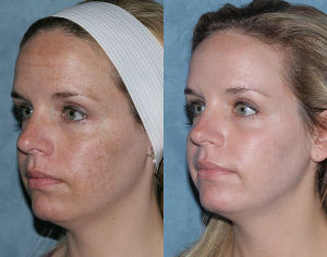 Fotografija prije i poslije razlomka pomlađivanje lica