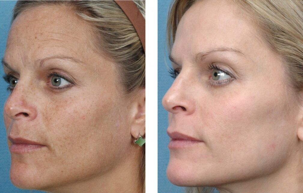 prije i poslije pomlađivanja kože lica