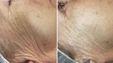 prije i poslije laserskog pomlađivanja kože