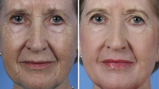 frakcijsko pomlađivanje lica prije i poslije fotografija