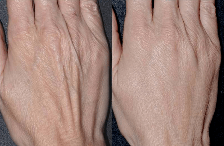 konturna plastika, pomlađivanje ruku fotografija 2 prije i poslije