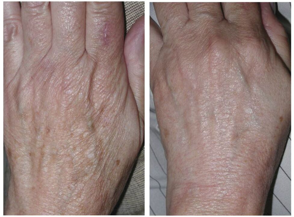lasersko pomlađivanje ruku prije i poslije fotografija